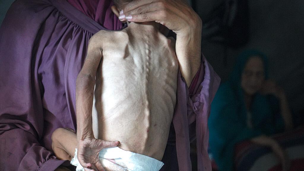 联合国:加沙或将全面饥荒 32万儿童急性营养不良