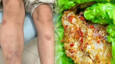 深圳6岁男童全身大片发青血肿 竟因吃生菜包烤肉