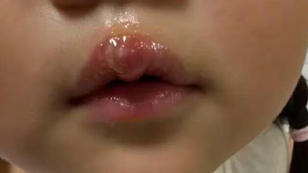 幼儿园教师用热熔胶枪烫孩子嘴 江苏丰县通报