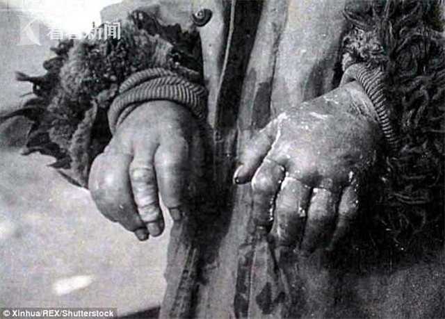 731部队油炸婴儿图片图片
