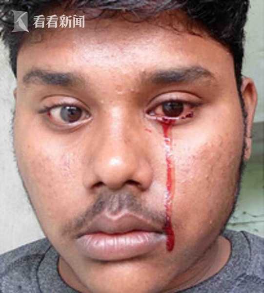 印度22岁男子两度流血泪 医生束手无策 原因成谜
